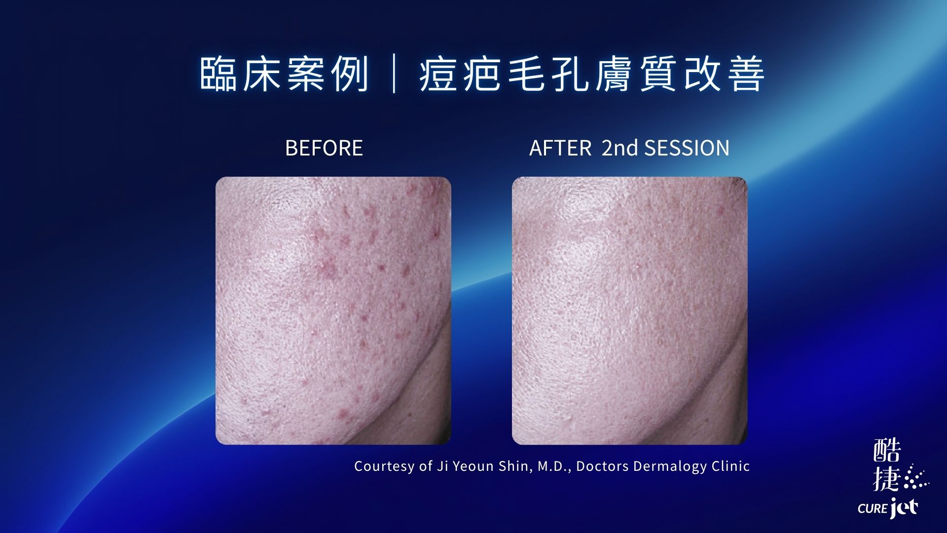 BA痘疤毛孔膚質改善